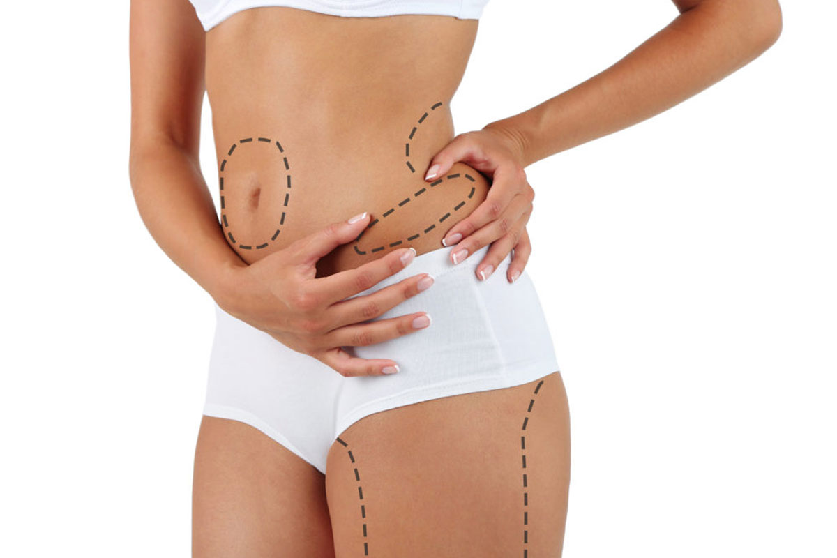 liposuction