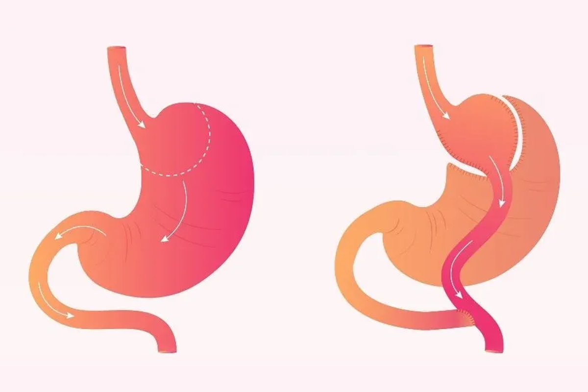 gastric-bypass-mide-kucultme