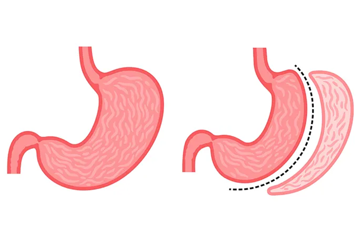 gastric-sleve-tup-mide